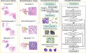 To better understand breast cancer, you need to understand how any cancer can develop and how many types of breast cancer and what are their characteristics. Automated Grading Of Breast Cancer Histopathology Using Cascaded Ensemble With Combination Of Multi Level Image Features Sciencedirect