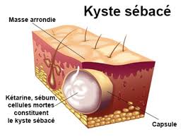 Également connu sous le nom de kyste. Kyste Definition Docteurclic Com