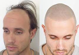 La tricopigmentazione (micropigmentazione del cuoio capelluto/smp) è un trattamento . I Benefici Della Tricopigmentazione 10 Motivi Per Scegliere La Micropigmentazione Dello Scalpo