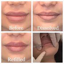 How long does it take to dissolve lip filler. Lip Injection Phases Lip Injections Botox Fillers Lip Injection