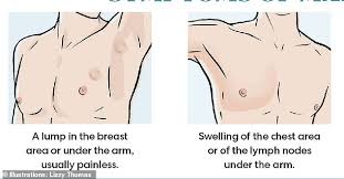 Similarities and differences in male and female breast cancer include: What Does A Male Breast Cancer Lump Look Like Male Breast Cancer Symptoms Diagnosis And Treatment The Male Breast Becomes Enlarged And Sometimes Tender