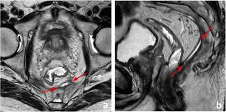 Polyps that become malignant are then called adenocarcinomas. Mri Of Rectal Cancer Relevant Anatomy And Staging Key Points Insights Into Imaging Full Text