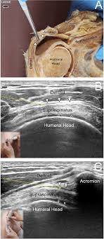 A tendon is a cord of strong tissue that connects muscles to bones. Ultrasound Guided Injection For The Subdeltoid Subacromial Bursa Notes Download Scientific Diagram