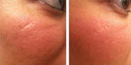 Treatment for acne scarring is considered cosmetic and is not a medical treatment. Laser Scar Removal In Dubai Dubai Cosmetic Surgery