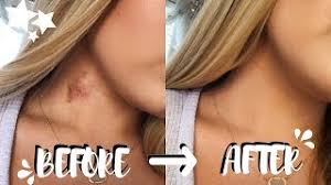 It has to be really cold. How To Get Rid Of Hickeys In Two Easy Steps No Color Correcting Brooklyn Anne Youtube