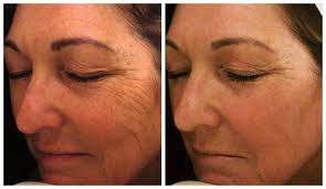 1540 fractional laser before and after. Laser For Skin Pigmentation Cocoon