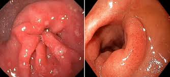 Image result for peptic ulcer