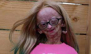 Is Adalia Rose Alive A Closer Look At Adalia S Condition And Her Parents Thenetline