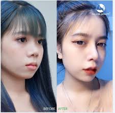 Nâng mũi tại Thu Cúc