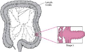 If the cancer spreads to other parts of the body, various other symptoms can develop. Colorectal Cancer Digestive Disorders Msd Manual Consumer Version
