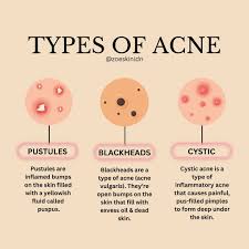 Image result for Pustule