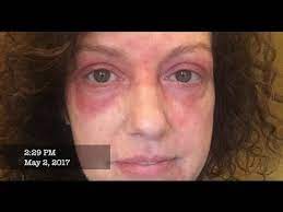 Dermatomyositis My Skin Signs And Symptoms Of Dermatomyositis Youtube You must be very careful about exercising if you have severe symptoms of myositis, such as severe muscle pain and weakness (a flare up).