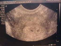 The ultrasound image is of twins at 4 weeks. This Was Taken At 4 Weeks 6 Days I Actually Told My Doctor That All I Wanted Her To Tell Me From The Ultrasoun Ultrasound Twins Ultrasound Ultrasound Pictures