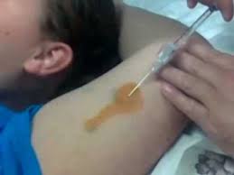 A hormonal implant is a tiny tube about the size of a matchstick. Implanon Birth Control Implantation Procedure Quick And Simple Youtube