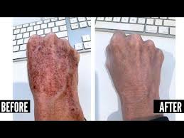 How I Got Rid Of Pigmentation On My Hands The Style Insider Dark Spots On Skin Remove Dark Skin Spots Brown Spots On Face