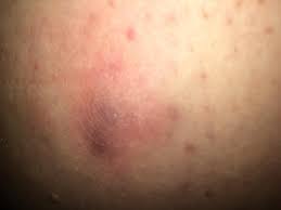 We've all had an itch that just needs to be scratched, but when that itch happens in our pubic area, things can get a little concerning. Can Anyone Tell Me What They Think This Is It Doesn T Hurt Much And No Itching Idk If It S An Ingrown Hair And I M A Little Worried If It Gets Too Irritated