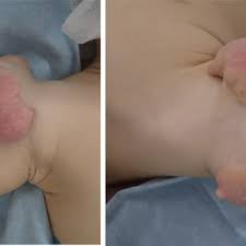 PDF) Nevus lipomatosus cutaneous superficialis