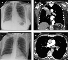 Image result for lung cancer xray