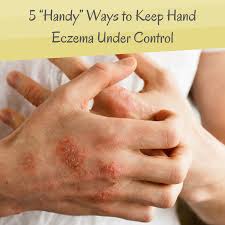 For Those Who Experience Hand Eczema In The Spring This Blog Post Is For You Find Out How To Keep It Under Control For Eczema On Hands Eczema Eczema Relief
