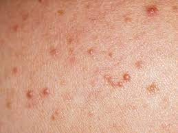 Du hast dir deinen urlaub mit sonne. Mallorca Akne Altmeyers Enzyklopadie Fachbereich Dermatologie