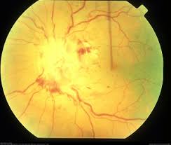 Image result for Hyperviscosity Syndrome