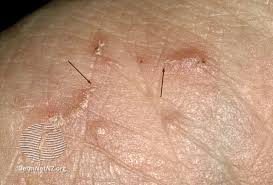 Image result for Sarcoptes scabiei