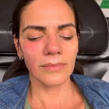 Prp injections! #prp #botox #reneedries