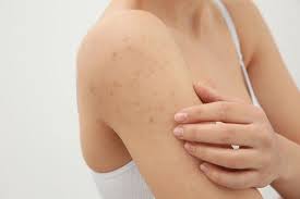 What to put on skin after waxing. How To Prevent Bumps And Acne After Waxing Thehealthmania
