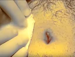 Surgical removal of ingrown hair. Ingrown Hair Cyst Removal Surgery From The Stomach Archives New Pimple Popping Videos