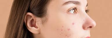 How The Sun Can Hurt and Help Your Acne