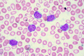 Chronische Lymphatische Leukamie Cll Non Hodkin Lymphoms