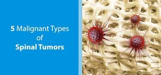 Visit our website to learn . 5 Types Of Malignant Spinal Tumors Nj Spine Orthopedic