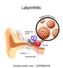 Image result for Bacterial Labyrinthitis