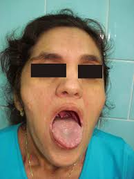 Síndrome de Plummer-Vinson: relato de caso