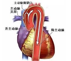 上集說到，陳先生被突如其來的主動脈撕裂症狀導致不醒人事，心臟科醫生奉召趕到博愛醫院。到底病人最後可否吉人天相﹖ 記者：朱晉傑 第四集：主動脈撕裂 僅三間醫院可救命 屯門醫院當值的心臟科專科葉醫生立刻趕往博愛，同時博愛的醫護團隊則將陳先生送入深切治療部，沿. å¾žä¸­é†«çš„è§'åº¦èªæ¸…å¿ƒè‡Ÿä¸»å‹•è„ˆç—…è®Š æ­¤ç—‡ç‹€å¾ˆæ£˜æ‰‹ æ¯æ—¥é ­æ¢