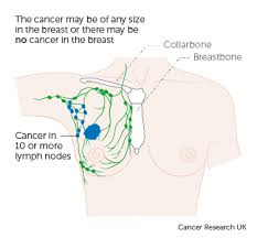 Sometimes breast cancer can spread to the lymph nodes under the arm or around the collar bone if you're diagnosed with breast cancer, your doctor will immediately try to figure out if it has spread, and if so, how far. Stage 3 Breast Cancer Cancer Research Uk