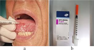 Image result for Systemic Corticosteroid