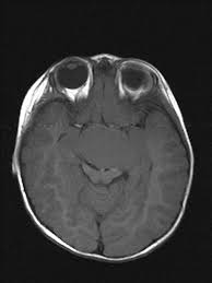 First signs are seen at birth. Pallister Hall Syndrome Radiology Case Radiopaedia Org