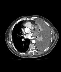 We did not find results for: Pleural Mesothelioma Radiology Case Radiopaedia Org