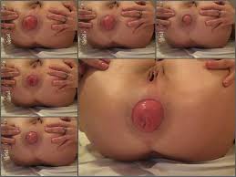 Prolapse After Anal | Anal - Unique Amateur Mature Stretched Her Giant  Prolapse Asshole Very Closeup