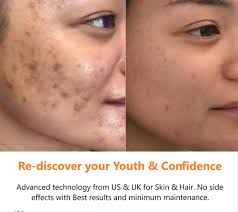 Perfumes and preservatives in cosmetic can also cause pigmentation. Female Acne Acne Scars Open Pores Pigmentation Dark Circles Treatment Erode Salem 18 To 60 Id 21447264262
