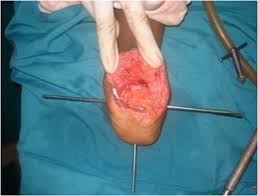 The purpose of this work is to increase the awareness of this infection that is still not diagnosed in our context by moroccan practitioners, as well as to show the medical treatment limits in madura foot. Madura Foot The Foot And Ankle Online Journal