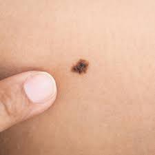 We may earn commission from links on this page, but we only recommend products we back. How To Detect Skin Cancer On Clients And What To Say If You Do