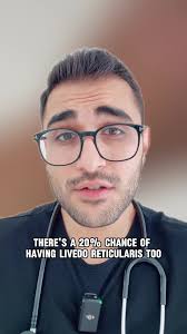 Migraines and Livetto Reticularis: Understanding the Connection