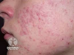 Image result for acne face