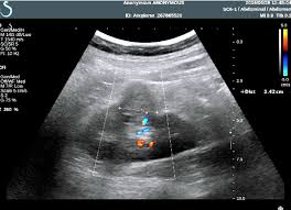 Basic facts about dromedary camel: Vietnamese Medic Ultrasound Case 513 Kidney Tumor Mimicking Dromedary Hump Dr Phan Thanh Háº£i Dr Nguyá»…n Minh Thiá»n Medic Medical Center Hcmc Vietnam