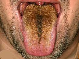 Black tongue is one of those conditions within the wide realm of the medical world of which even professionals haven't nailed even though it is not known exactly how it affects bacteria and yeast that leads to black tongue, it is. Black Hairy Tongue Disease Causes Diagnosis Symptoms Treatment