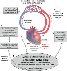 Image result for Right Heart Failure