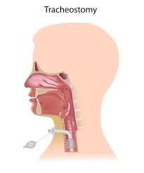 Throat cancer causes, signs and symptoms. Treatment Of Throat Cancer Net Health Book