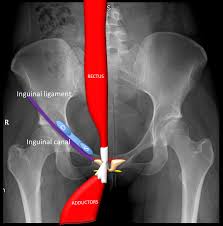 The inguinal ligament (or poupart's ligament) is a fibrous band extending from the anterior superior iliac spine to the pubic tubercule. Epos Trade